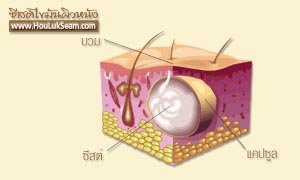 ฮั้วลักเซียมกับซีสต์ไขมันผิวหนัง
