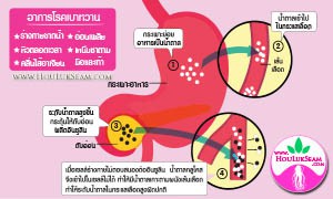 การรักษาโรคเบาหวานด้วยแพทย์แผนจีน