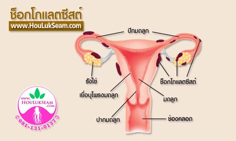 ช็อกโกแลตซีสต์