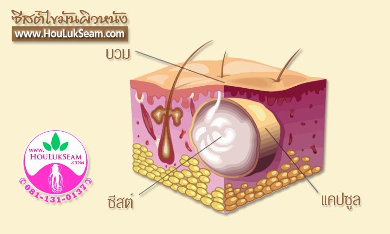 ฮั้วลักเซียมกับซีสต์ไขมันผิวหนัง