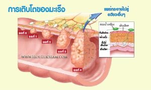 ฮั้วลักเซียมกับระยะโรคมะเร็ง