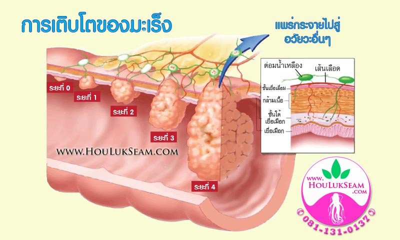 โรคมะเร็ง